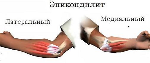 Эпикондилит