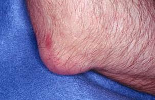 Подагра локтя