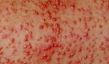 Потница у взрослых симптомы