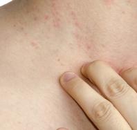 Потница у взрослых