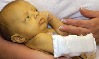 Повышенный билирубин у новорожденного