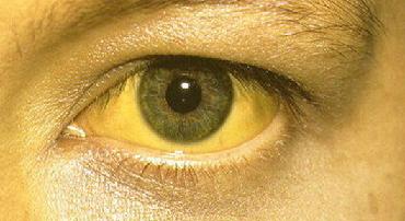 Повышенный билирубин в крови