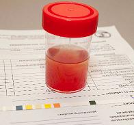 Причины крови в моче у мужчин