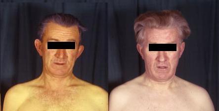 Синдром Жильбера