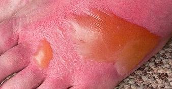 Термический ожог симптомы