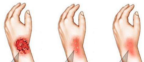 Термический ожог степени