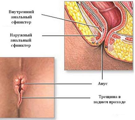 Трещина заднего прохода причины