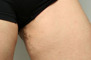 Варикозное расширение вен малого таза симптомы