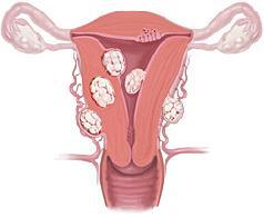 Варикозное расширение вен малого таза