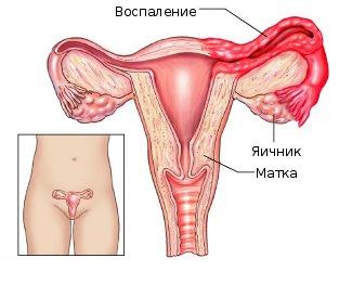Воспаление придатков причины