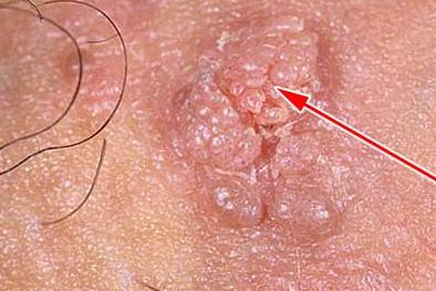 остроконечные кондиломы у женщин фото