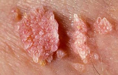 кондиломы у женщин симптомы