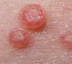 кондиломы у женщин