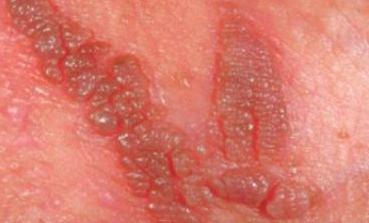 остроконечные кондиломы у женщин