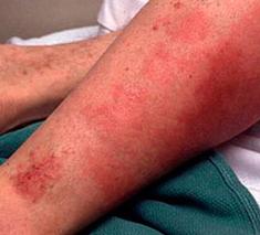 рожа на ноге