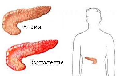 воспаление поджелудочной железы причины