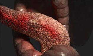 воспаление поджелудочной железы симптомы