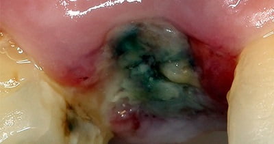 Альвеолит лечение