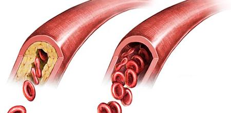 Атеросклероз лечение