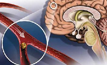 Атеросклероз причины