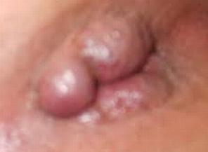 Боли в заднем проходе геморрой