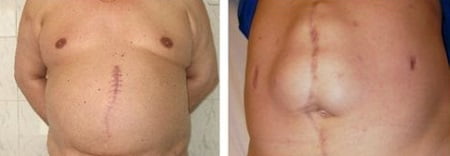 Грыжа белой линии живота фото