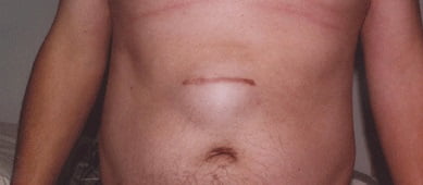 Грыжа белой линии живота