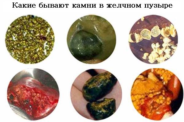 Камни в желчном пузыре симптомы