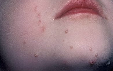 Контагиозный моллюск фото