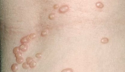 Контагиозный моллюск лечение