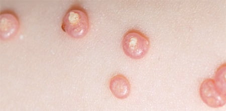 Контагиозный моллюск симптомы