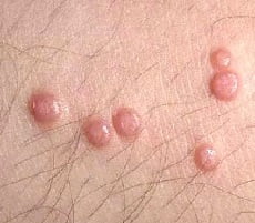 Контагиозный моллюск