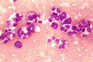 Пониженные нейтрофилы в крови