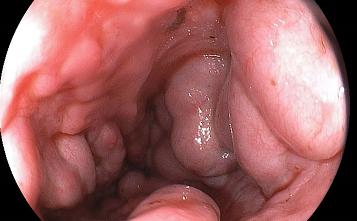 Варикозное расширение вен пищевода фото