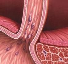 Варикозное расширение вен пищевода