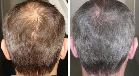 Диффузное выпадение волос
