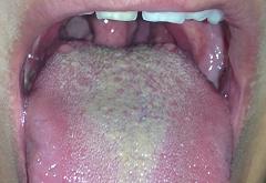 Бело желтый налет на языке