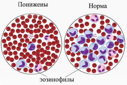 эозинофилы понижены причины