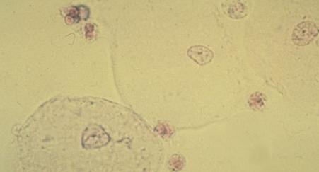эпителий в моче причины