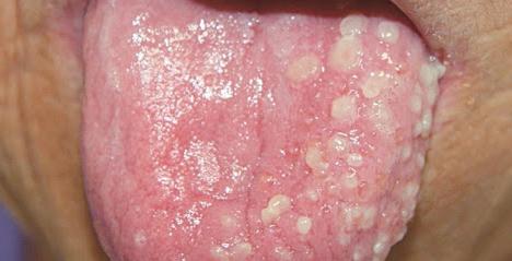 стоматит на языке