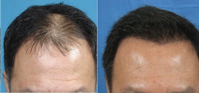 выпадение волос у мужчин причины