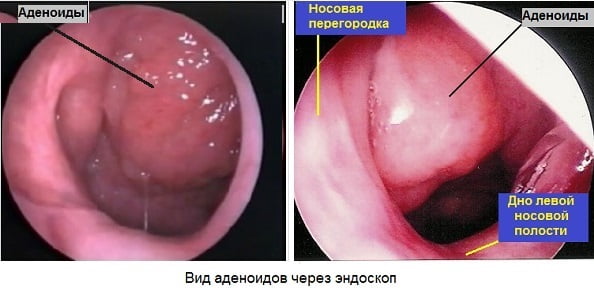 Аденоиды у детей фото