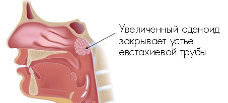 Аденоиды у взрослых лечение