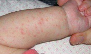 Аллергия на молоко фото 2