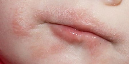 Аллергия на молоко фото