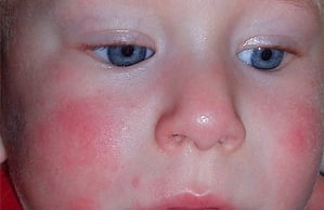 Аллергия на яйца фото