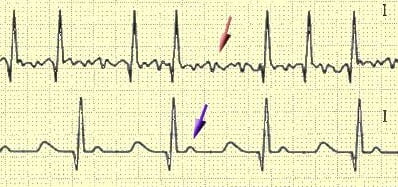 Аритмия сердца диагностика