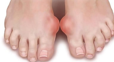 Артрит стопы фото