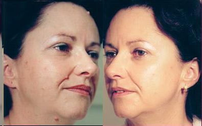 Бородавки на лице фото до и после