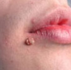 Бородавки на лице как избавиться